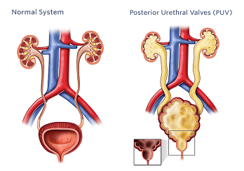 PUV (Posterior Urethral Valves) and its complications