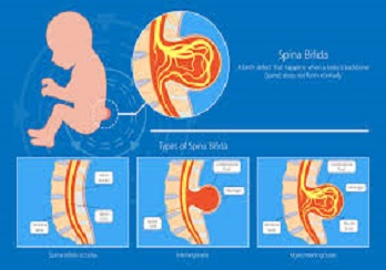 Spinal column surgery, spina bifida, ngb