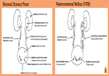VUR (Reflux of urine above into the kidneys) Urinary Tract Infections