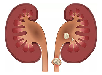 Pediatric Stone Diseases Comprehensive Pediatric Stone Center