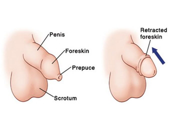 Phimosis Prepucial Diseases, Meatal stenosis