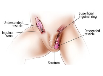 Undescended Testes