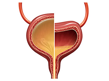 Neurogenic Bladder