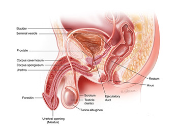 Hypospadias