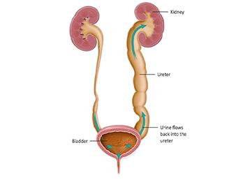 Vesicoureteric Reflux (VUR)