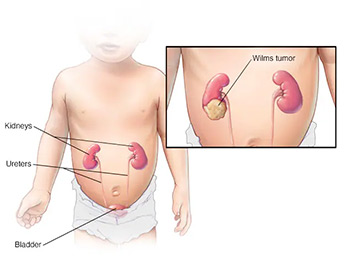 Wilms Tumor